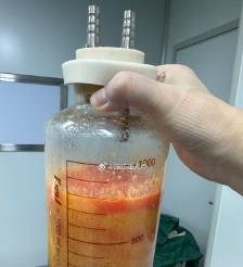 连云港水动力吸脂手术要做多久？